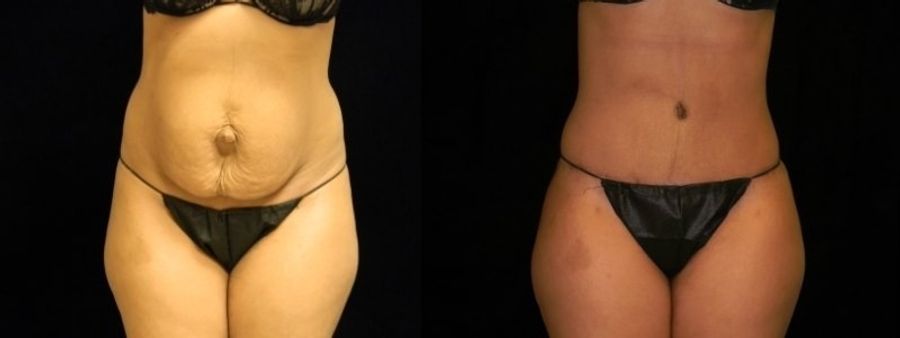Before and after Tummy Tuck case 32648