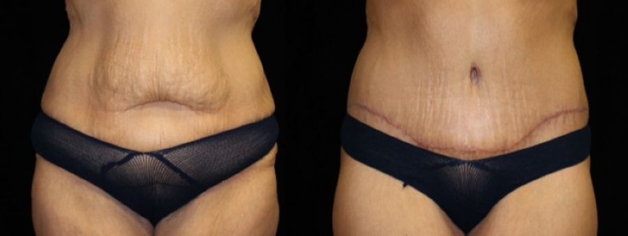 Before and after Tummy Tuck case 32694