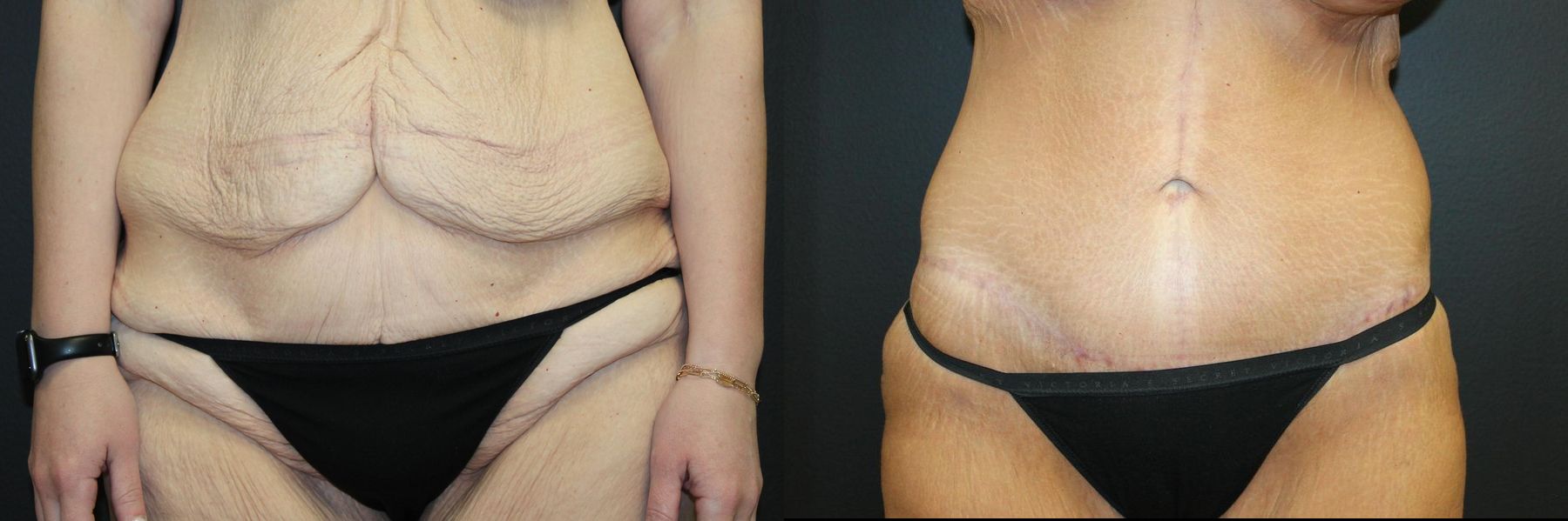 Before and after Tummy Tuck case 32735