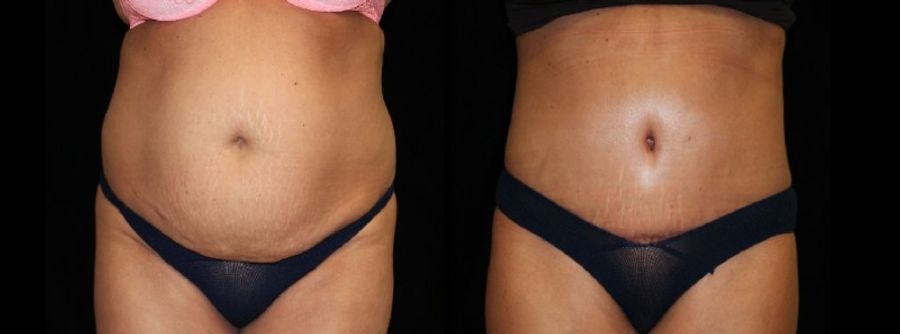 Before and after Tummy Tuck case 32581