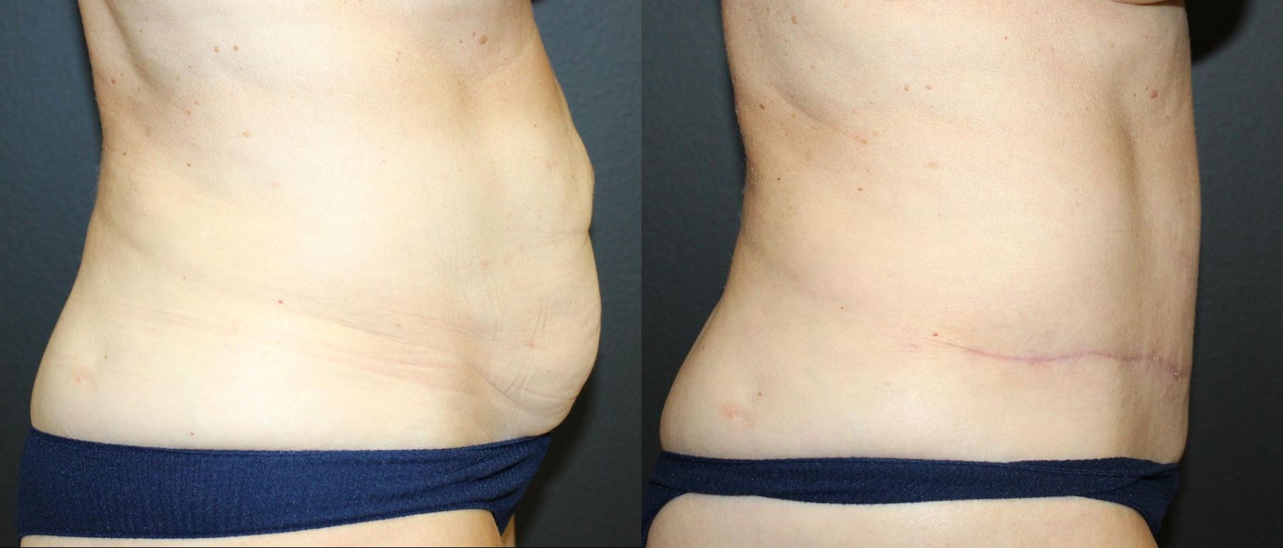 Before and after Tummy Tuck case 32675 - Angle 3