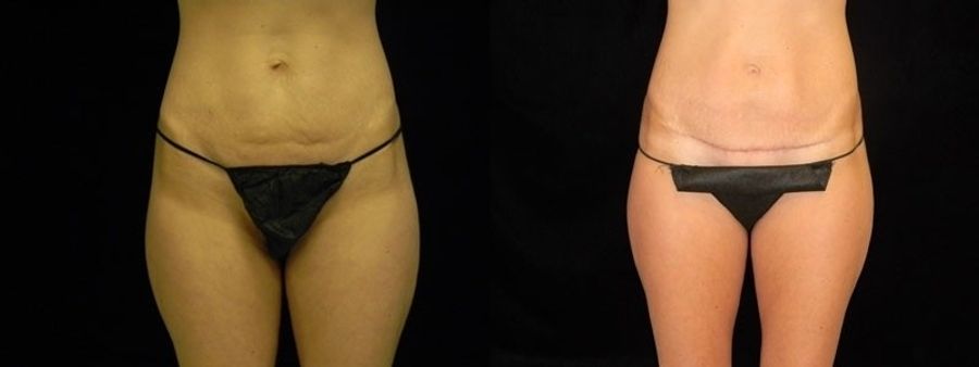 Before and after Tummy Tuck case 32687