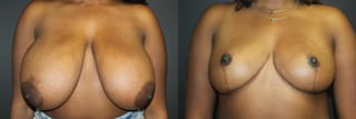 Before and after Breast Reduction case 32768 - Angle 1