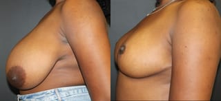 Before and after Breast Reduction case 32768 - Angle 2