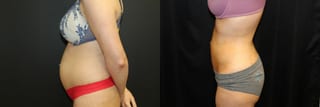Before and after Liposuction case 32769 - Angle 2