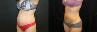 Before and after Liposuction case 32769 - Angle 3