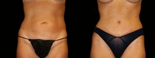 Before and after Tummy Tuck case 32578 - Angle 1