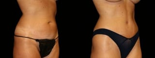 Before and after Tummy Tuck case 32578 - Angle 2