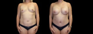 Before and after Mommy Makeover case 32579 - Angle 1