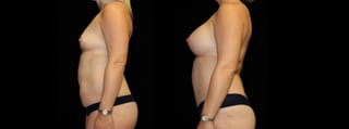 Before and after Mommy Makeover case 32579 - Angle 2