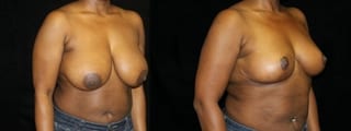 Before and after Breast Reduction case 32580 - Angle 2