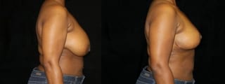 Before and after Breast Reduction case 32580 - Angle 3