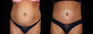 Before and after Tummy Tuck case 32581 - Angle 1