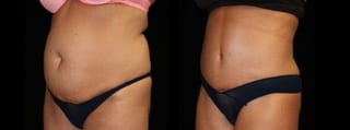 Before and after Tummy Tuck case 32581 - Angle 2
