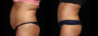 Before and after Tummy Tuck case 32581 - Angle 3