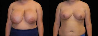 Before and after Breast Reduction case 32582 - Angle 1