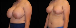 Before and after Breast Reduction case 32582 - Angle 2