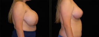 Before and after Breast Reduction case 32582 - Angle 3