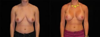 Before and after Breast Augmentation with Lift case 32583 - Angle 1