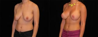 Before and after Breast Augmentation with Lift case 32583 - Angle 2