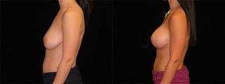 Before and after Breast Augmentation with Lift case 32583 - Angle 3