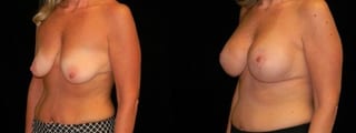 Before and after Breast Augmentation with Lift case 32584 - Angle 2