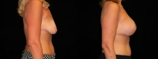 Before and after Breast Augmentation with Lift case 32584 - Angle 3