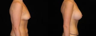 Before and after Mommy Makeover case 32585 - Angle 2