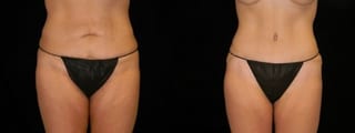 Before and after Mommy Makeover case 32585 - Angle 3