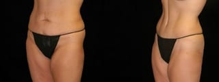 Before and after Mommy Makeover case 32585 - Angle 4
