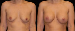 Before and after Breast Augmentation case 32586 - Angle 1