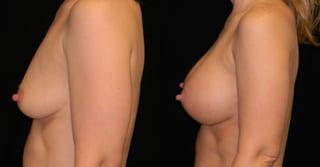 Before and after Breast Augmentation case 32586 - Angle 3