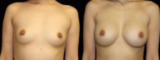 Before and after Breast Augmentation case 32587 - Angle 1