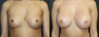 Before and after Breast Augmentation case 32588 - Angle 1