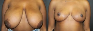 Before and after Breast Reduction case 32591 - Angle 1