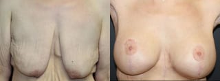 Before and after Breast Augmentation with Lift case 32592 - Angle 1