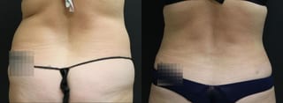 Before and after 360 Body Contour case 32593 - Angle 4