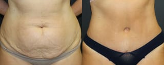 Before and after 360 Body Contour case 32594 - Angle 1