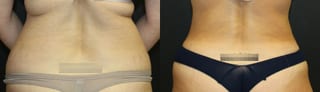 Before and after 360 Body Contour case 32594 - Angle 4