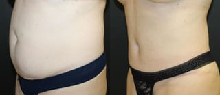 Before and after 360 Body Contour case 32595 - Angle 2
