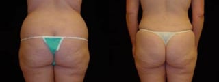 Before and after 360 Body Contour case 32597 - Angle 2