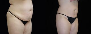 Before and after 360 Body Contour case 32598 - Angle 1