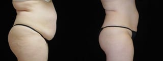 Before and after 360 Body Contour case 32598 - Angle 2