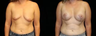 Before and after Breast Augmentation with Lift case 32599 - Angle 1