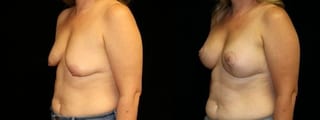 Before and after Breast Augmentation with Lift case 32599 - Angle 2