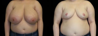 Before and after Breast Reduction case 32600 - Angle 1