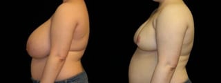 Before and after Breast Reduction case 32600 - Angle 3