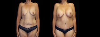 Before and after Mommy Makeover case 32601 - Angle 1