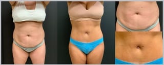 Before and after 360 Body Contour case 32602 - Angle 1