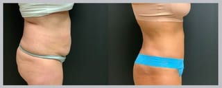 Before and after 360 Body Contour case 32602 - Angle 2